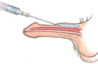 A dangerous method of enlarging the penis using petroleum jelly injections